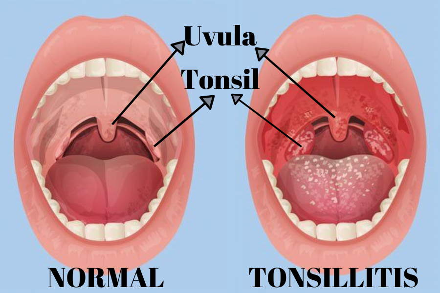 tonsillitis-all-that-you-should-know-living-herself